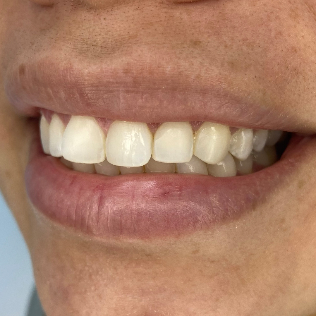 Porcelan veneers changes