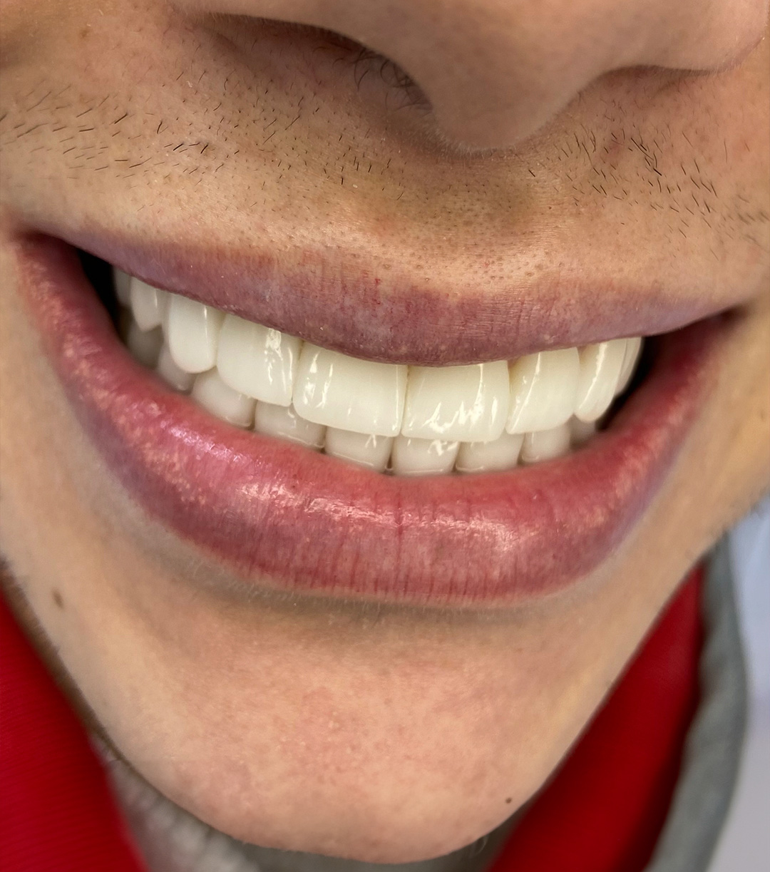 Porcelan Veneers