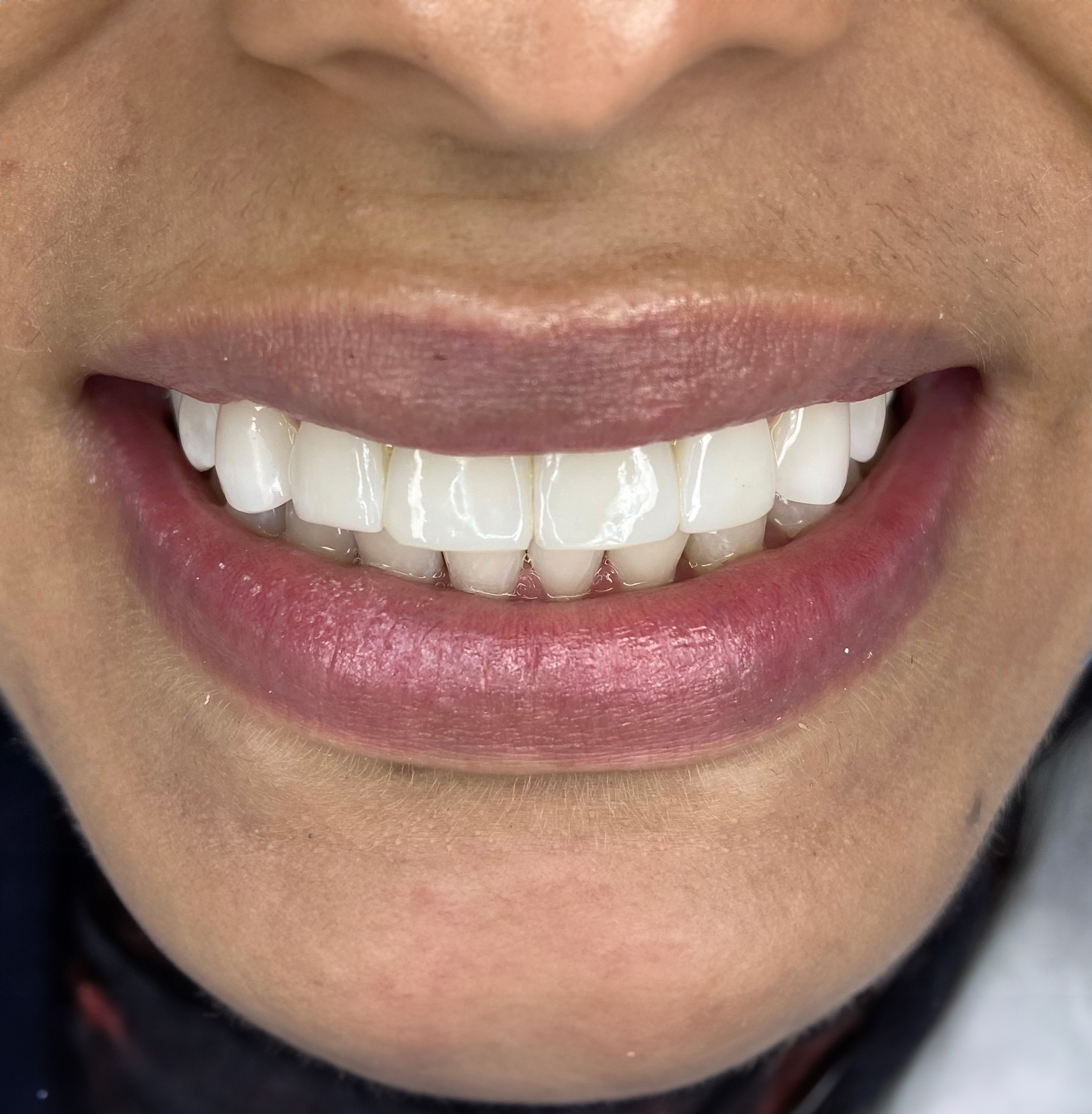 Resin veneers